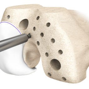 conformis_portfolio_iduo_synthes3d_image_1