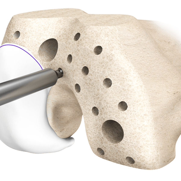 conformis_portfolio_iduo_synthes3d_image_1