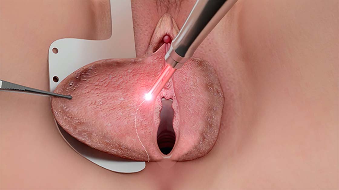 Nymphoplastie : Tout Savoir sur la Chirurgie Intime Féminine