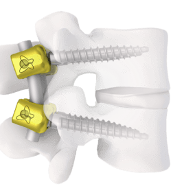 SPINEART - Degen L3L4 - SYNTHES'3D