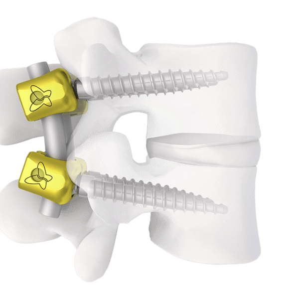 SPINEART - Degen L3L4 - SYNTHES'3D